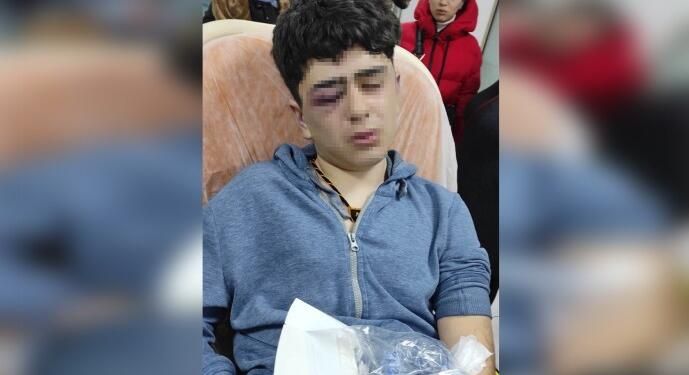 Police torture 14-year-old Kurdish boy in Turkey, leaving him at risk of losing an eye 1